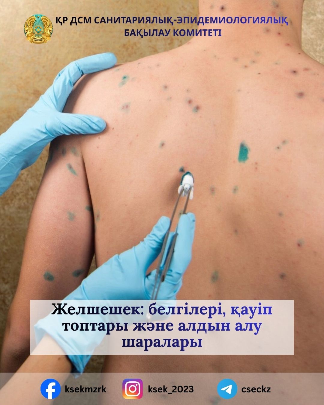 Ветряная оспа: симптомы, группы риска и меры профилактики